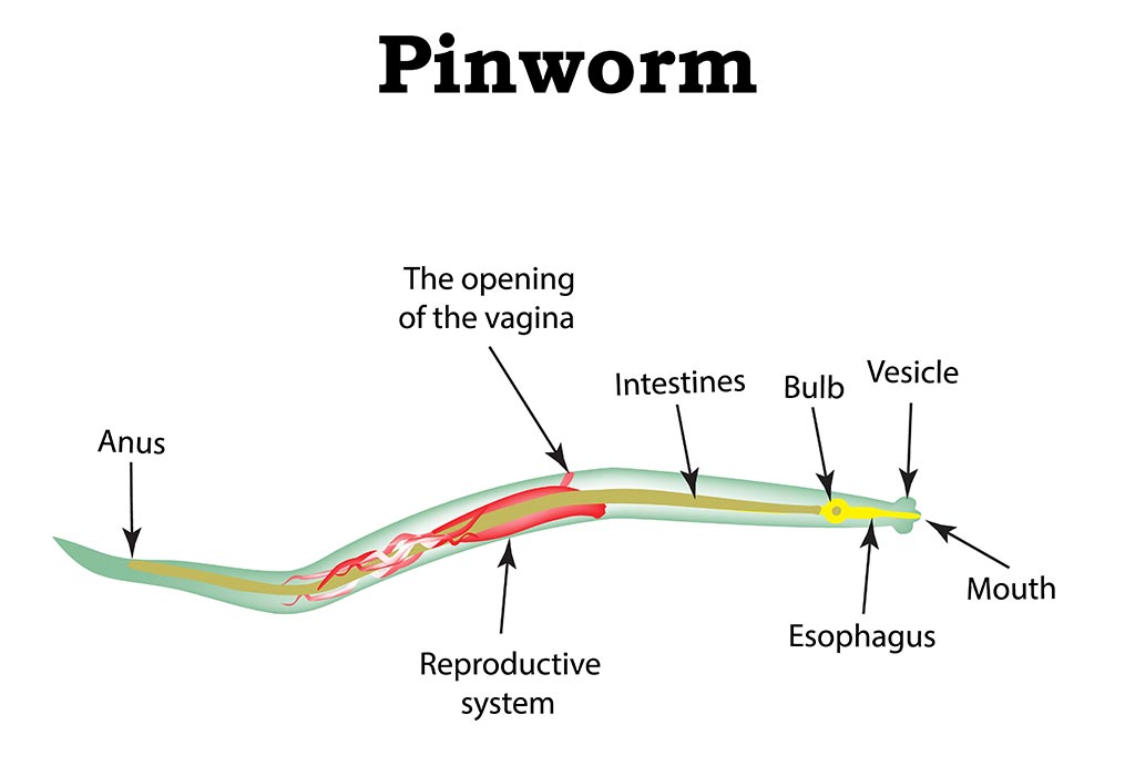 terhes pinworms)