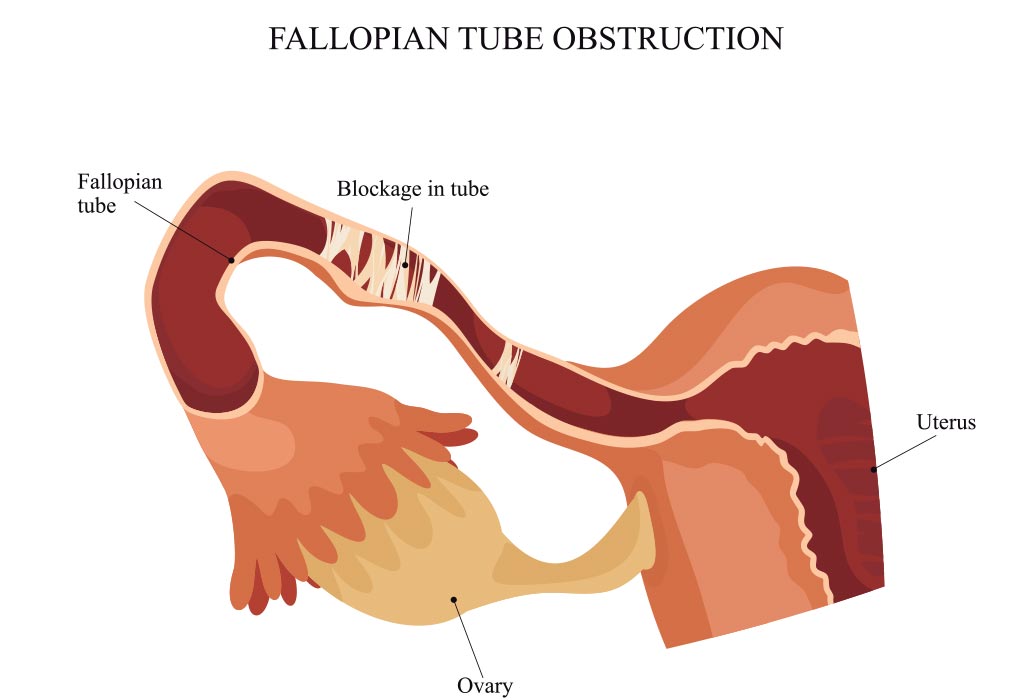 फैलोपियन ट्यूब का सुचारु रुप से काम करना 