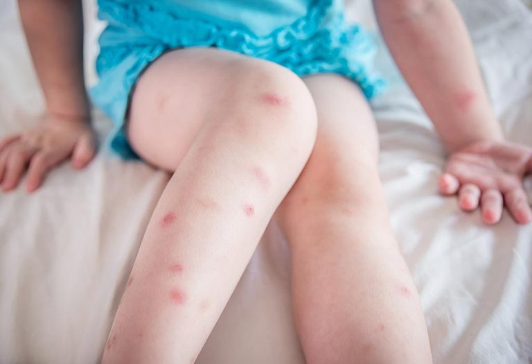 Scars in Children – Causes and Remedies