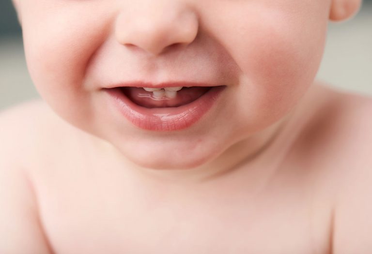 Teething in Toddler - Symptoms & Remedies