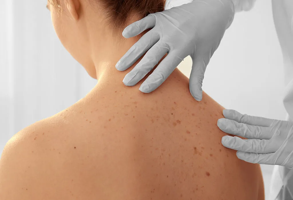 Moles During Pregnancy