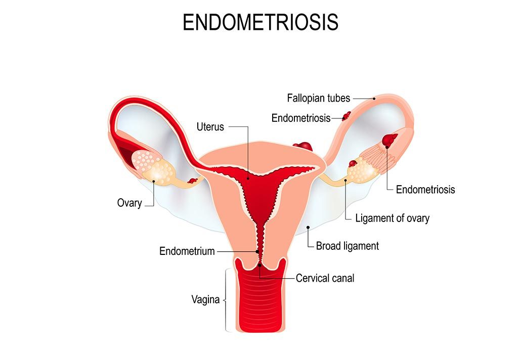 How to Get Pregnant With Endometriosis