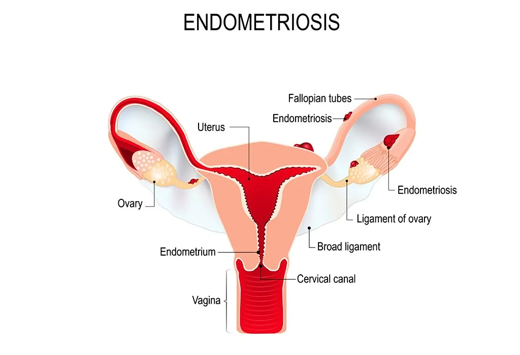 How to Get Pregnant With Endometriosis How to Get Pregnant With Endometriosis