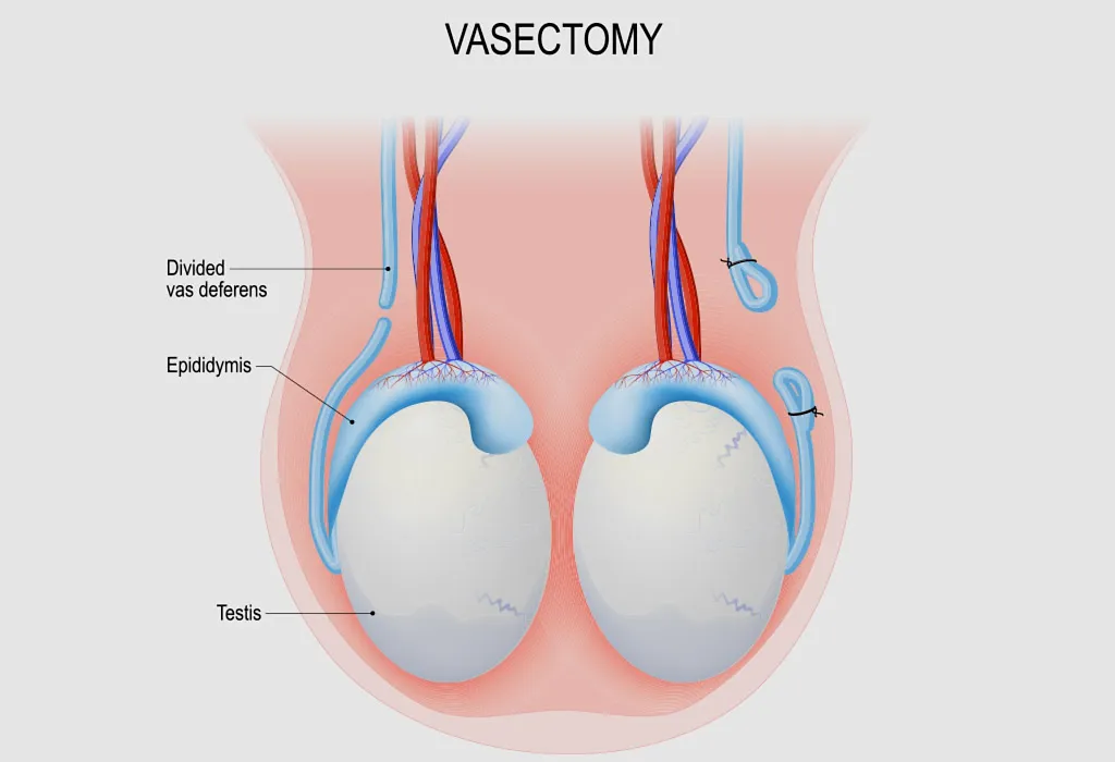 Vasectomy Vasectomy