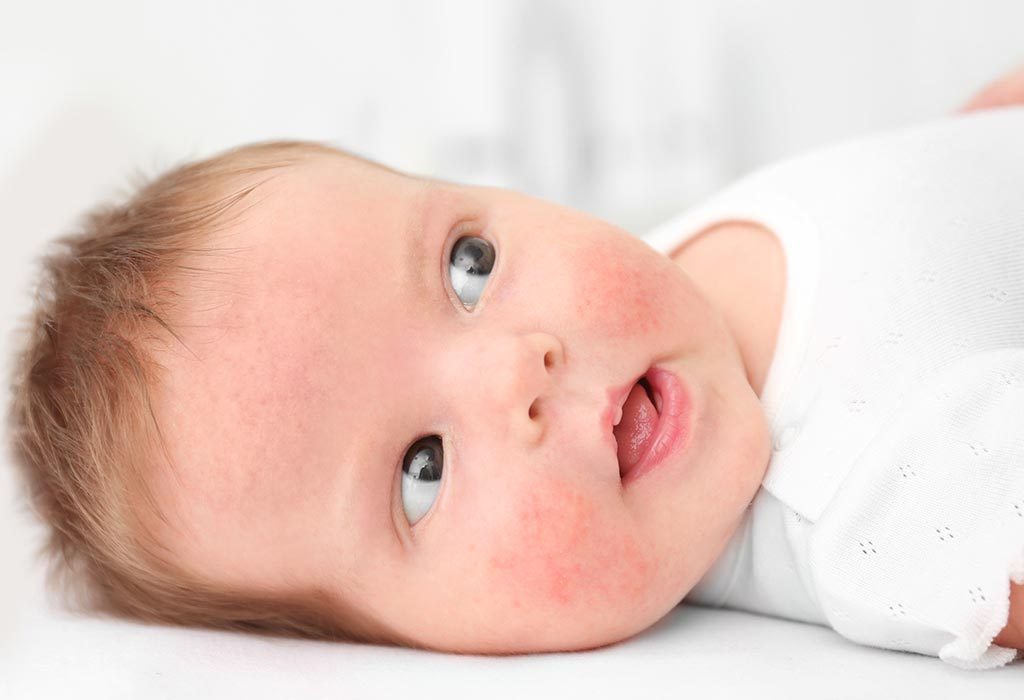 Wheat Allergy In Babies Signs And Tips To Handle It