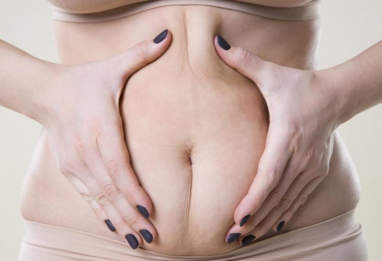 Cellulite During Pregnancy - Causes, Treatment, and Prevention