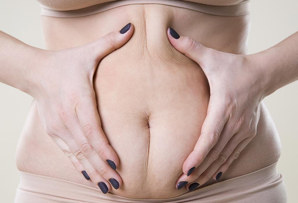 Cellulite When Pregnant Causes Treatment Prevention