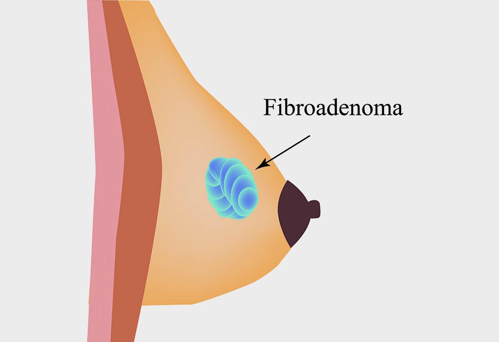 Lump In Breast While Breastfeeding Types Treatment Prevention