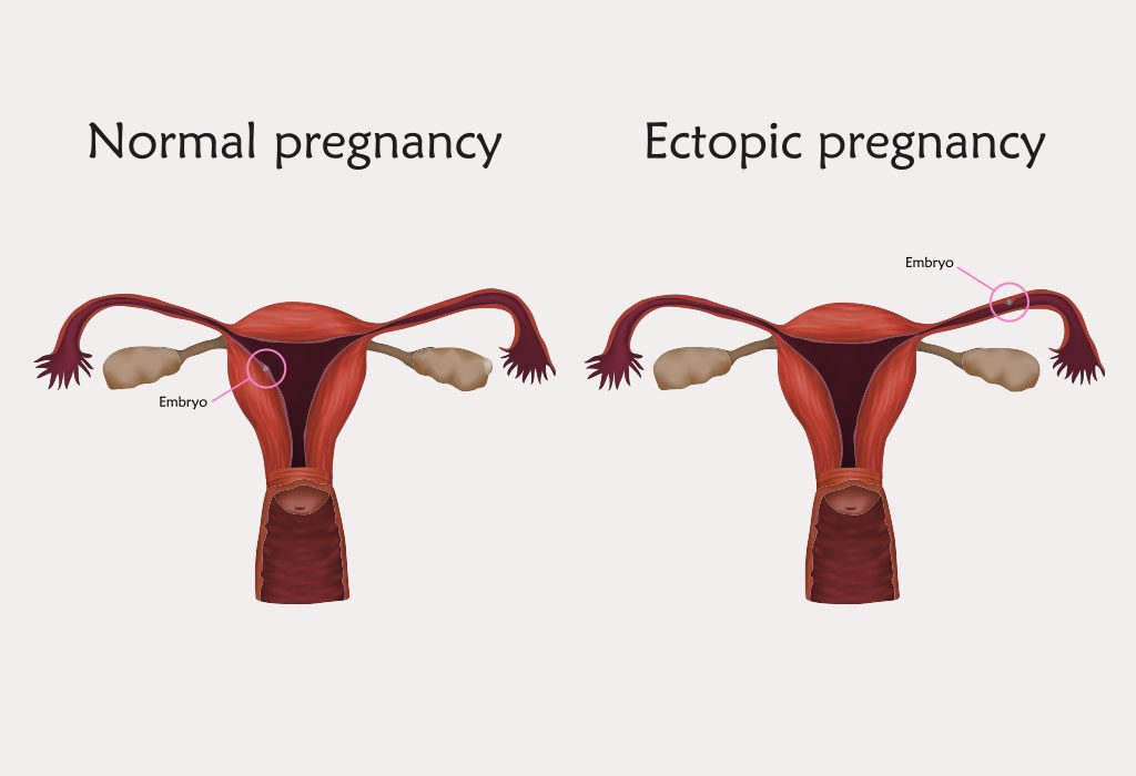 Can You Get Pregnant After an Ectopic Pregnancy