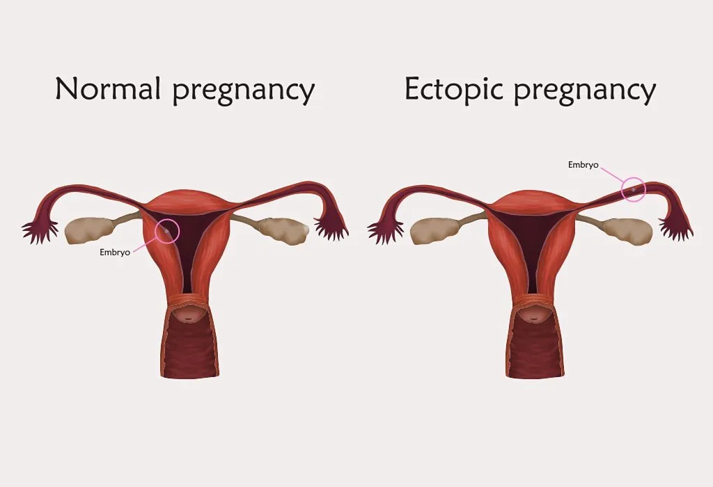 Normal Pregnancy and Ectopic Pregnancy