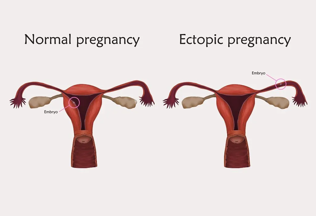 What is the recovery process after ectopic pregnancy treatment