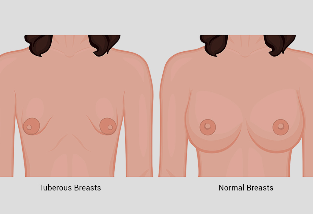 Comparație diagramatică între sânii tuberoși și sânii normali