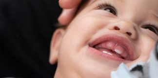 शिशुओं के टेढ़े दाँत निकलना - कारण और उपाय