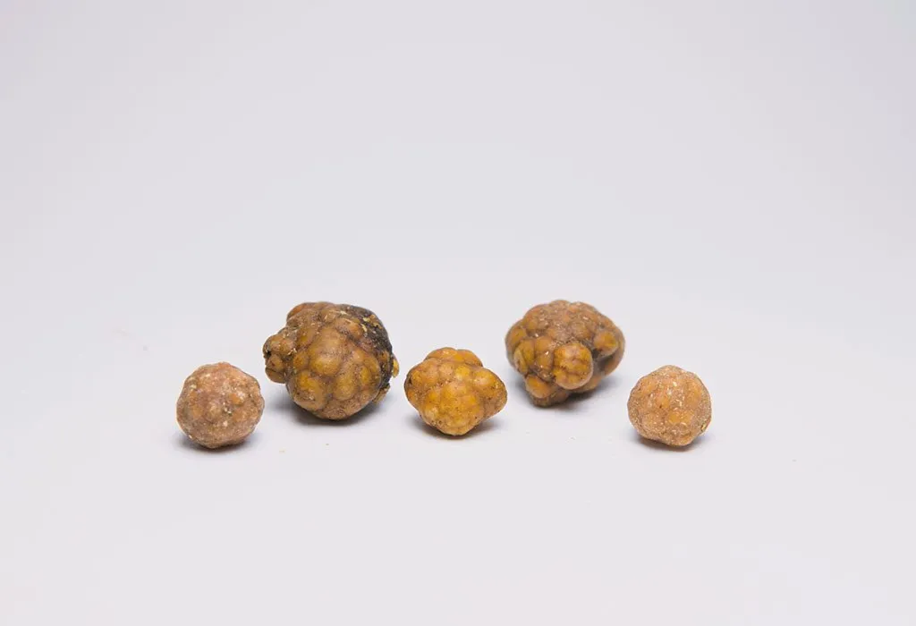 Gallstones in Children - Types, Causes, Symptoms & Treatment