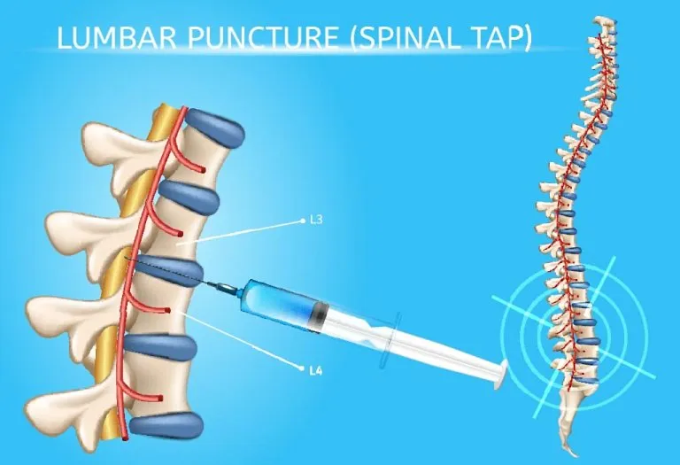 Lumbar Puncture (Spinal Tap) in Children