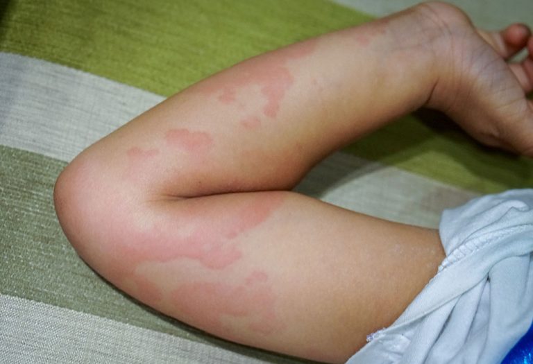 Papular Urticaria in Children - Causes, Symptoms, and Treatment