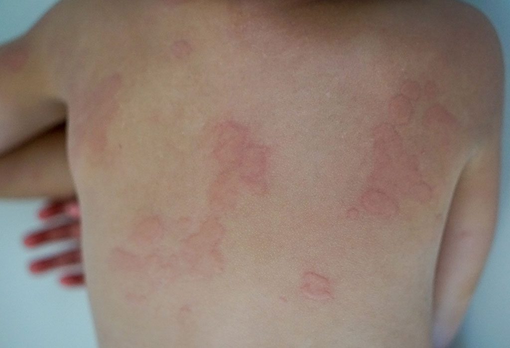 What Is Chronic Urticaria In Toddlers