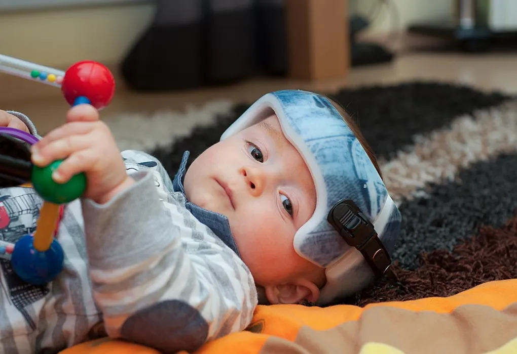 Baby wearing an orthopaedic helmet
