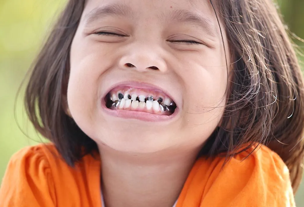 Broken Teeth in Kids – Causes, Treatment, and Prevention