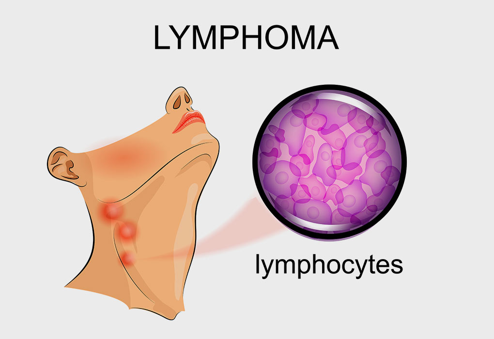 unfolder lymphoma