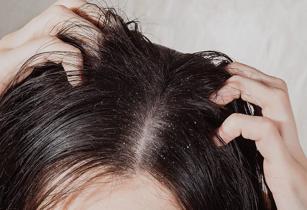 Itchy and dandruff scalp in kids