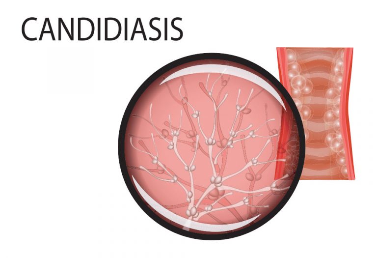 Getting Pregnant with Yeast Infection Is It Possible?