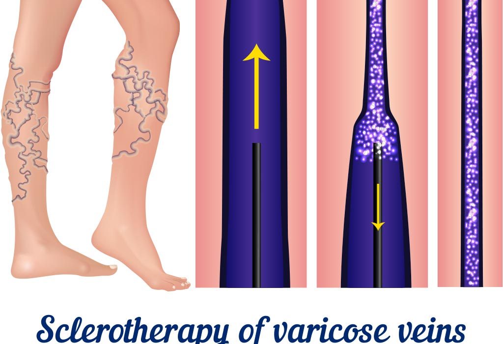 Sclerotherapy of varicose veins