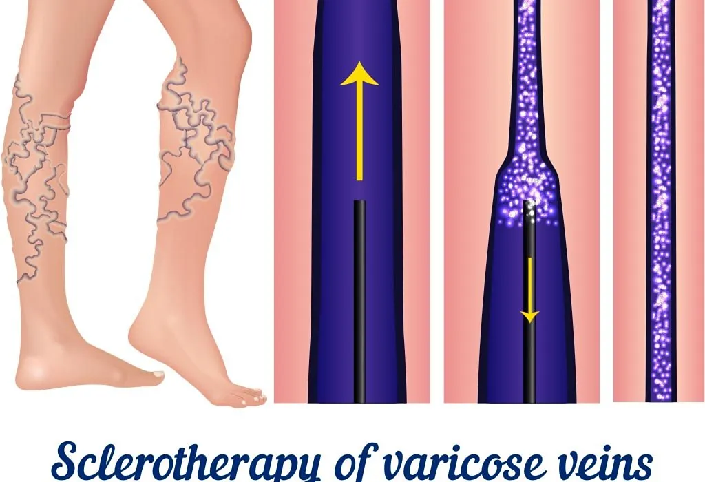 Try sclerotherapy.