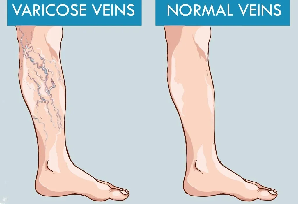 What Are the Signs and Symptoms of Postnatal Varicose Veins?