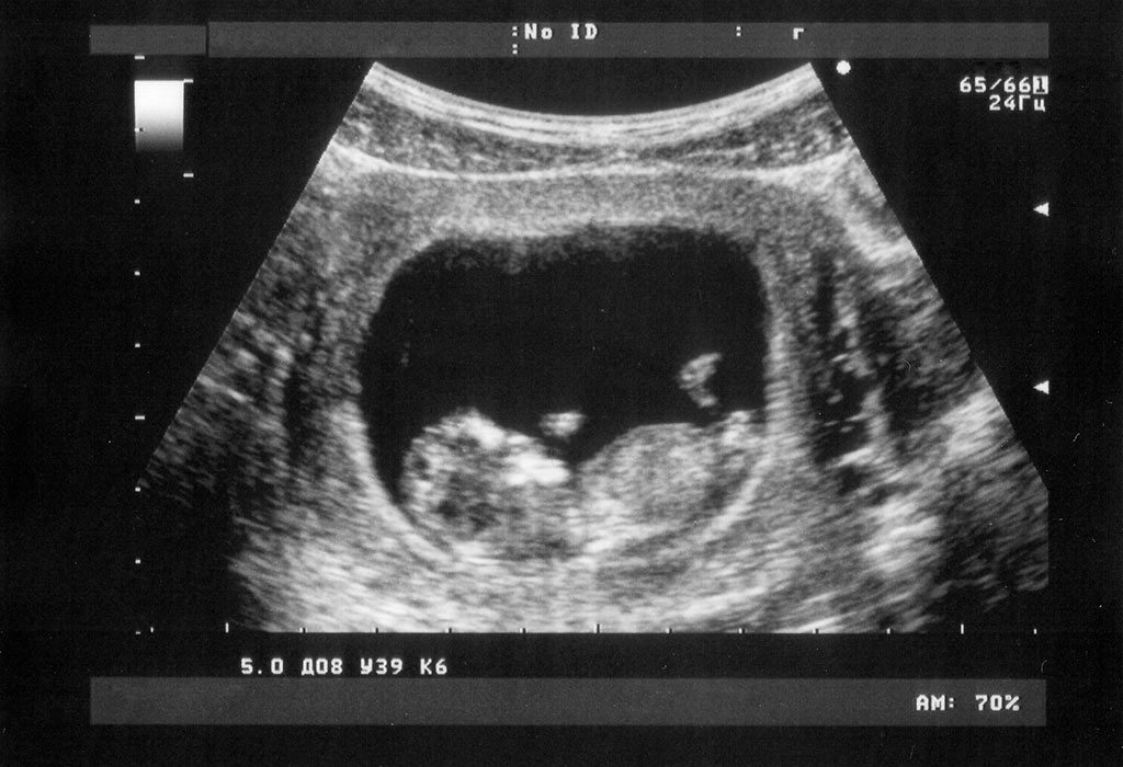 early sonogram picture