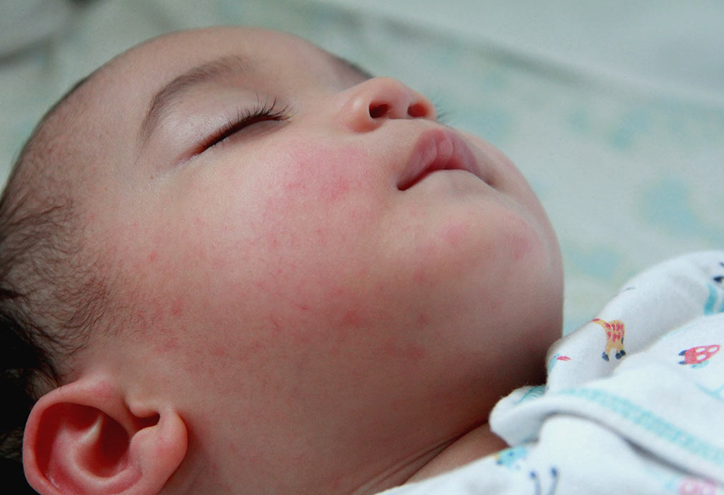 In What Forms Are Hydrocortisone Cream Available?