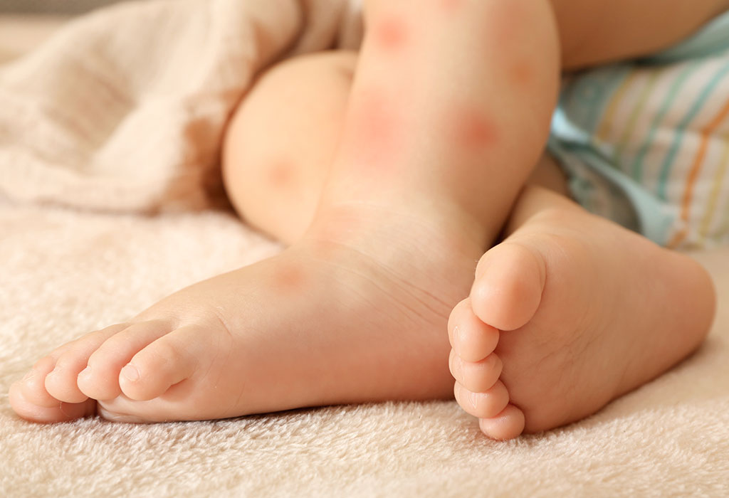 Formula Allergy In Babies Causes Symptoms Alternatives