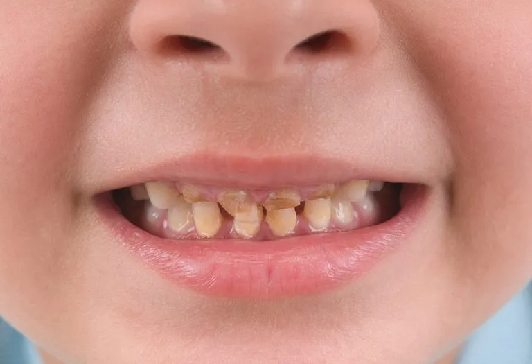 Yellow and Other Discolouration of Teeth in Children