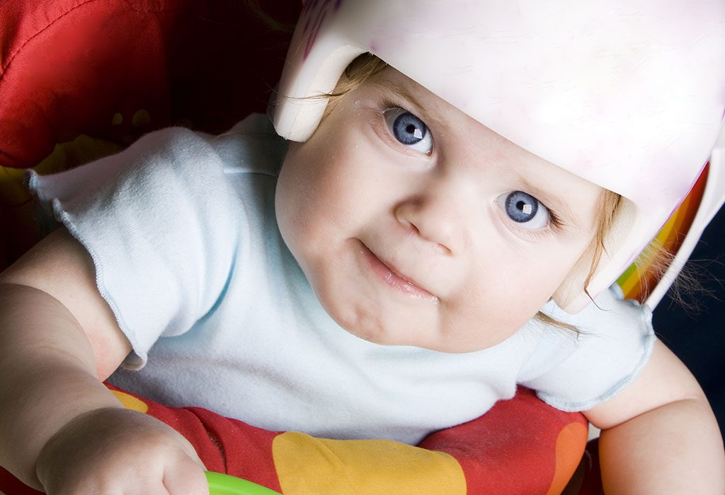 Plagiocephaly, Positional Plagiocephaly, Flat Head Syndrome: Causes &  Treatment