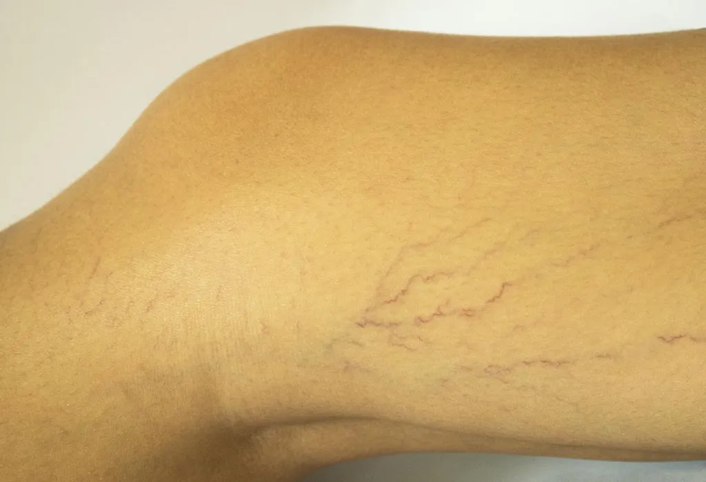 Presence of Varicose Veins