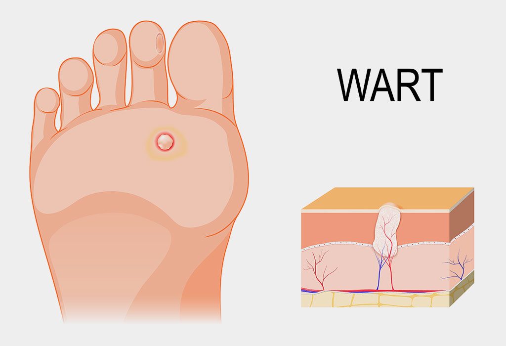 Plantar warts