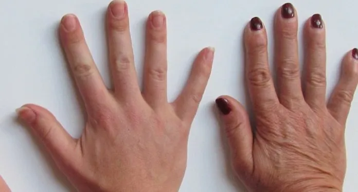 Do You Have Veiny Hands? Check 7 Causes of Veins Popping Out