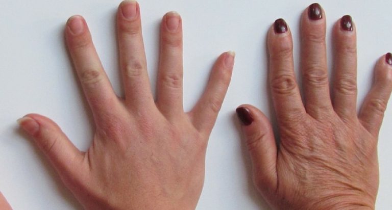 Do You Have Veiny Hands? 7 Causes Behind Veins Popping Out