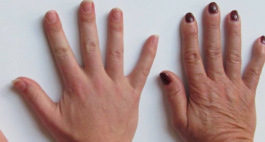 Do You Have Veiny Hands 7 Causes Why Veins Pop Out