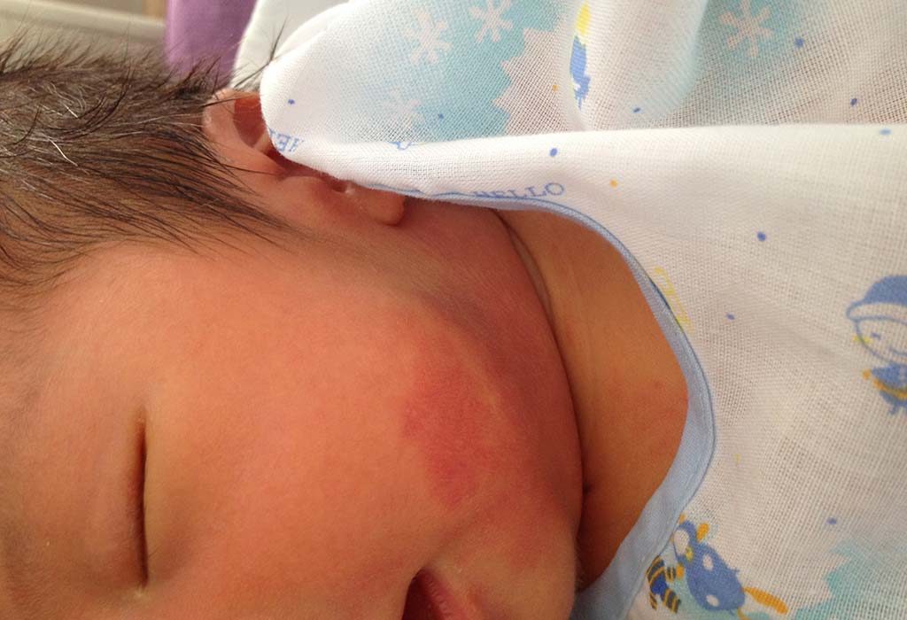 Strawberry Nevus Strawberry Nevus
