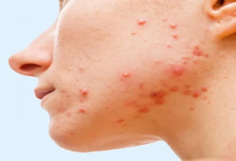 Say BYE-BYE to Cystic Acne
