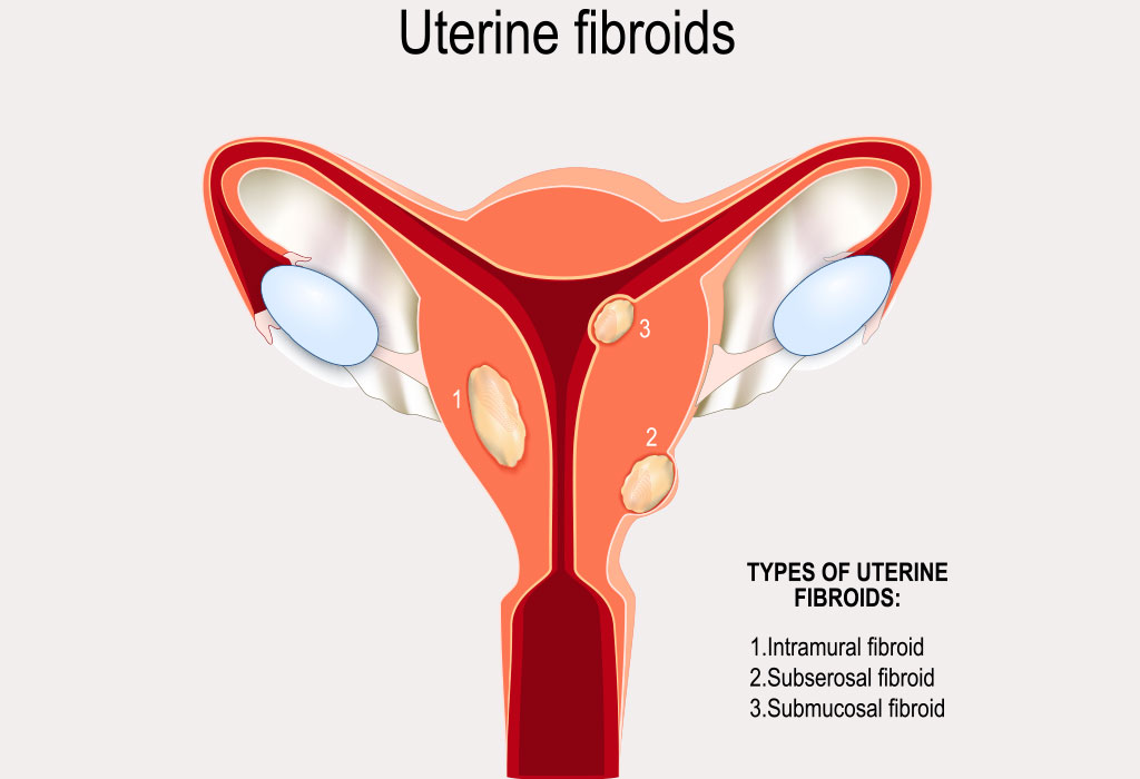 https://cdn.cdnparenting.com/articles/2018/09/28171504/Uterine-Fibroids.jpg