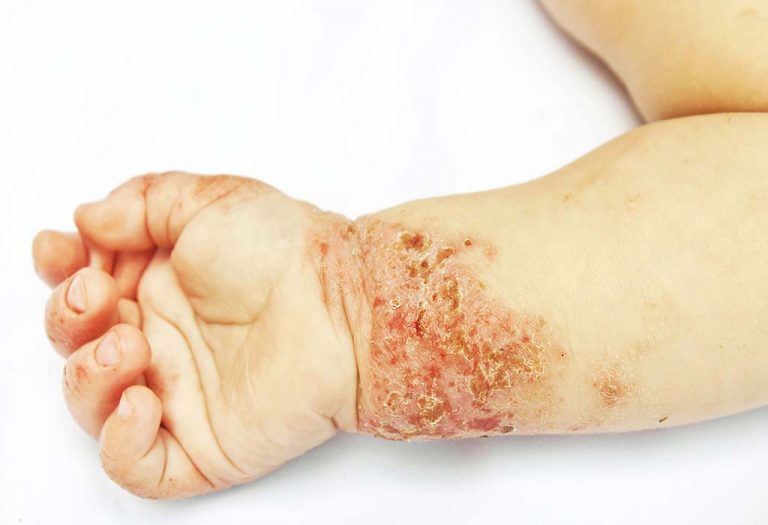 Skin Discoloration in Babies Causes & Home Remedies