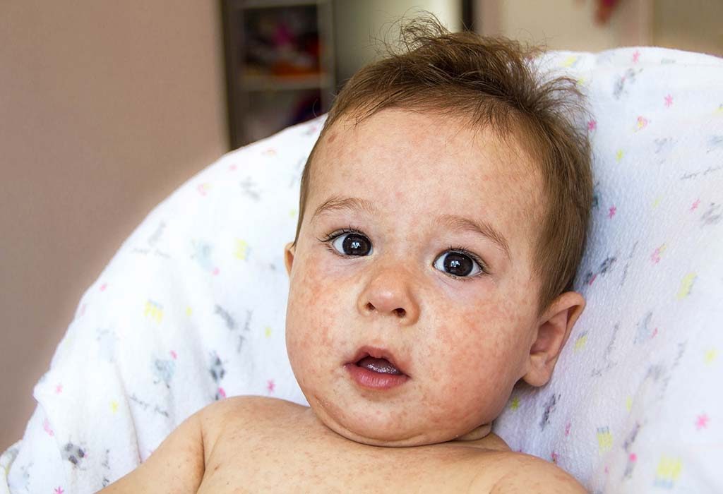 Does Skin Discolouration in Babies Signal a Serious Problem?