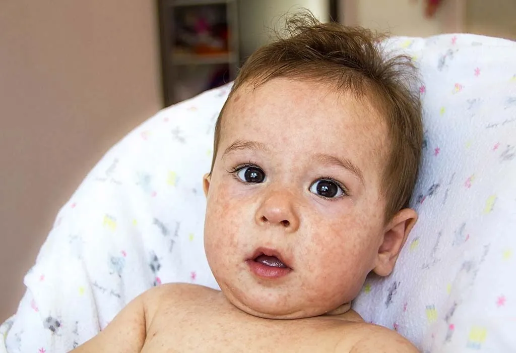 Skin Discoloration in Babies Causes Home Remedies