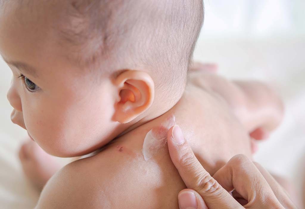 Ringworm Infection Ringworm Infection
