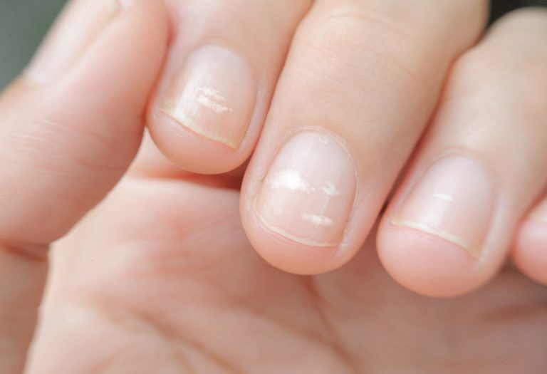 White Spots on Your Child's Nail - Should You Be Worried