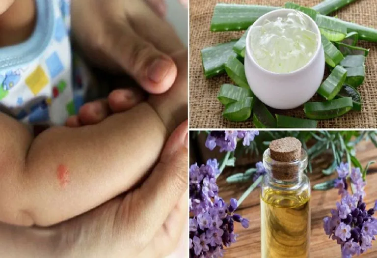 12 Natural Home Remedies To Relieve Your Child From Painful Insect Bites