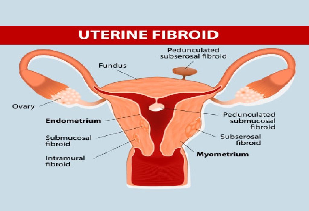 Uterine Fibroids: Affect on Infertility and Treatment