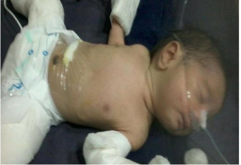 This Maharashtra Newborn Baby Had a Twin Brother Growing INSIDE Him! Here's What All Mothers Should Know About the Incident